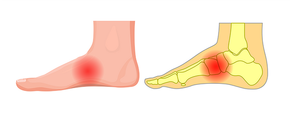 Foot pain in deals arches