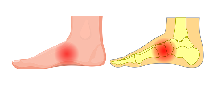 Pain in the Arch of the Foot? What Does It Mean?