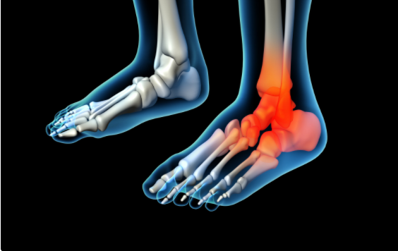 Inflammation: The Source of Foot Pain and the Solution