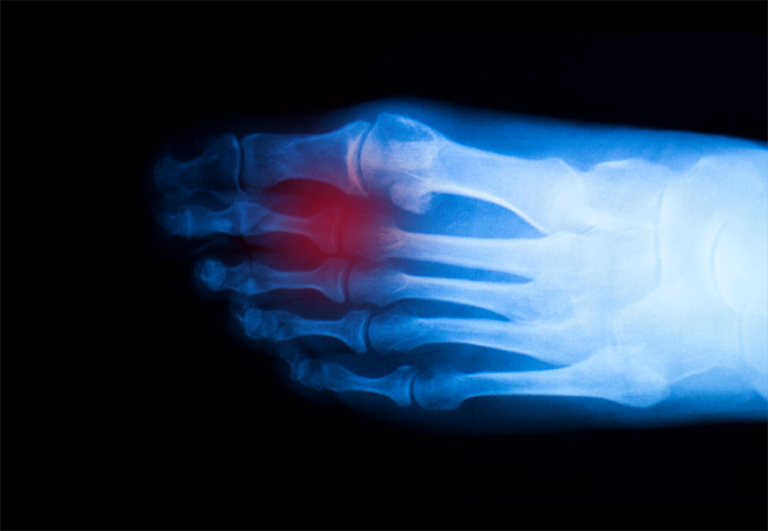 Broken Toe X Ray